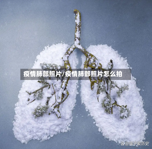 疫情肺部照片/疫情肺部照片怎么拍-第3张图片