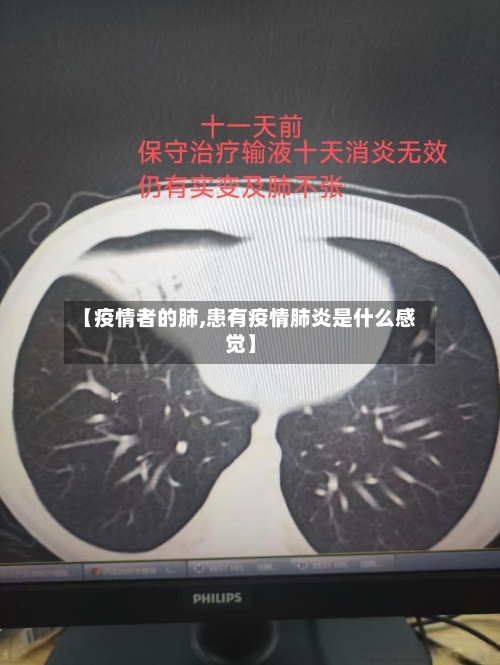 【疫情者的肺,患有疫情肺炎是什么感觉】-第2张图片