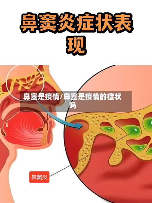 鼻塞是疫情/鼻塞是疫情的症状吗-第3张图片
