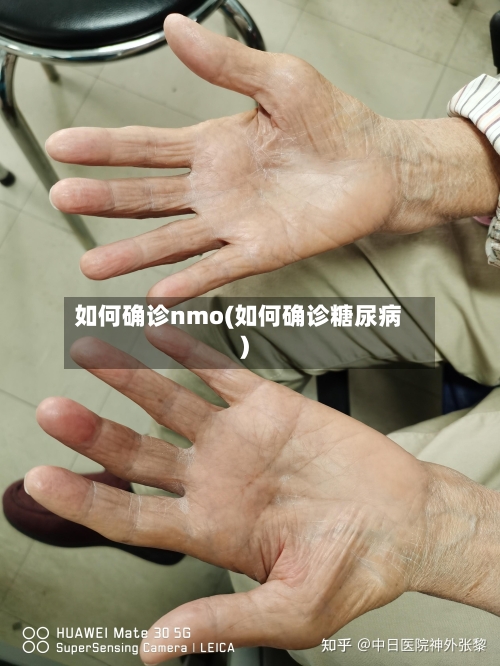 如何确诊nmo(如何确诊糖尿病)