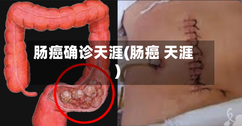 肠癌确诊天涯(肠癌 天涯)-第2张图片