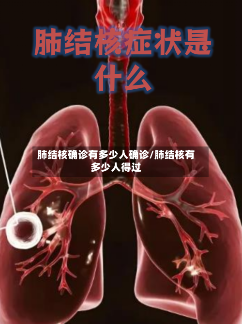 肺结核确诊有多少人确诊/肺结核有多少人得过-第2张图片