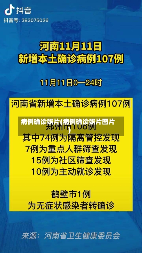 病例确诊照片(病例确诊照片图片)