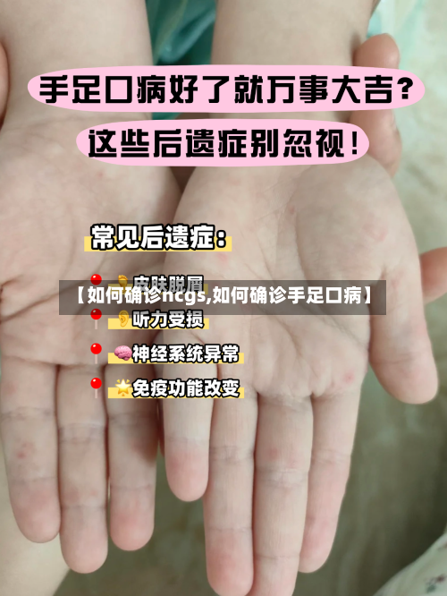 【如何确诊ncgs,如何确诊手足口病】-第2张图片