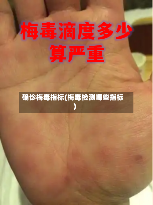 确诊梅毒指标(梅毒检测哪些指标)-第2张图片